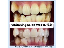 ホワイトニングサロン ホワイト(WHITE)/セルフホワイトニング/大阪/福島