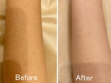 ドクターリバース(Dr.Reverse)/ヒジ下脱毛1回のみ施術、4ヶ月後