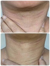 ウララ(ulala)/首にも◎