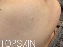 トップスキン 表参道(TOPSKIN)/ハーブピーリング専門店表参道