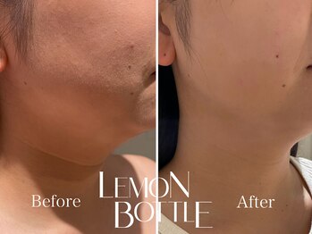 イデアルミー 大宮店(イデアルMe)/レモンボトル施術前・1週間後