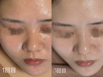 ウィハナ(wehana)/【ララピール】透明感アップ