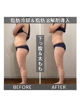 セターナルエス(Seternal.S)/脂肪冷却&脂肪分解剤導入