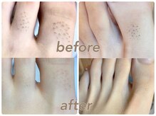 フルーブラン(Frubran)/【メンズ脱毛】45分打ち放題