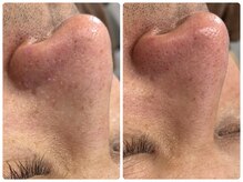 アンドエミニー エン ラボーテ(& EMINY 艶 la beaute)/毛穴洗浄