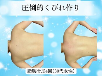 プリランティア 新宿店/背中二の腕くびれの脂肪冷却