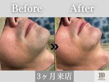 ビューティーアンドボディメイクBB シャオ西尾店/3ヶ月で効果を実感◎