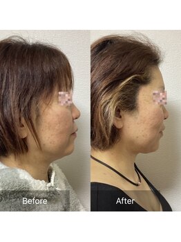 小顔整体 優/アゴライン大変身☆