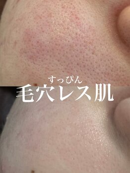 ルアナアイナ(Luana Aina)/ハーブピーリングで毛穴ケア