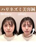 【2024年人気No.1】★食いしばり/むくみに ハリネズミ美容鍼￥23650→¥16500