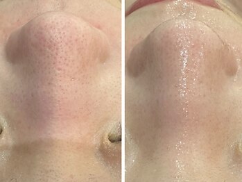 ケアナ 梅田店(CareNa)/ツヤ肌毛穴洗浄★ヒト由来幹細胞