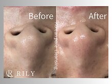 リリー(RILY)/【毛穴洗浄ビフォーアフター】