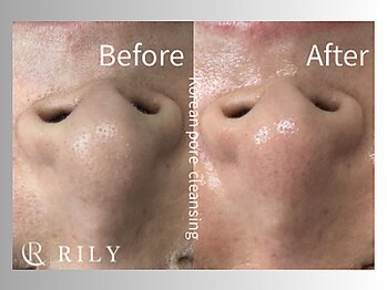 リリー(RILY)/【毛穴洗浄ビフォーアフター】