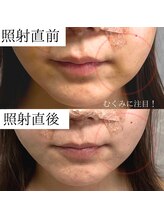 ヒカリエステ 六本木(HIKARI ESTHE)/腫れや痛みの短縮に