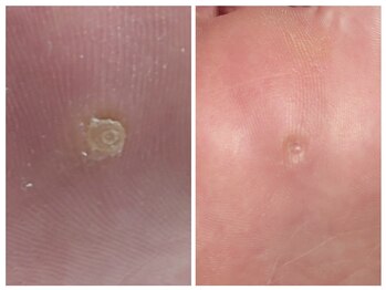 アンティ(Aunty)/魚の目(鶏眼)