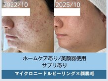 アロマ(AROMA)/凹凸跡/毛穴/越谷せんげん台