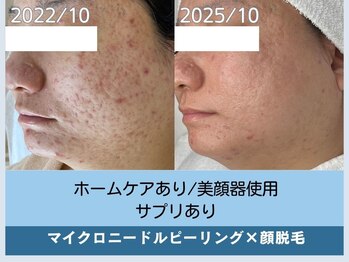 アロマ(AROMA)/凹凸跡/毛穴/越谷せんげん台