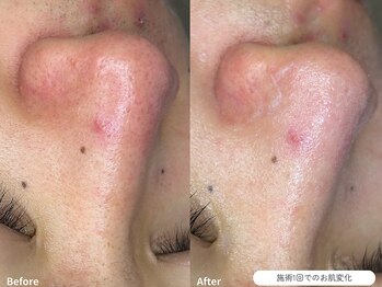 フォンビューティー(fon beauty)/毛穴ケア1回