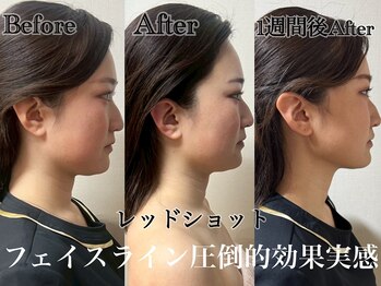 アンドエス 六本木(and S.)/二重アゴにレッドショット！