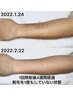 【メンズ脱毛】腕全体脱毛（ワキ/指/手の甲含む）腕も脇もつるつる！