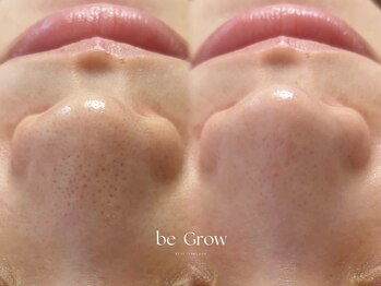 ビーグロウ(be Grow)の写真/【鼻筋毛穴フェイシャル】毛穴詰まりに集中アプローチ☆鼻筋すっきり!つるんと輝く素肌美人に!