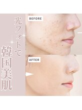 美バリ 新宿店(美BARI)/光の力でターンオーバーを早める