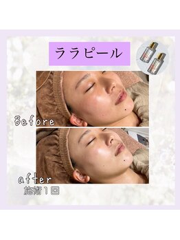 アンドナップ(nap)/乾燥肌、敏感肌でも大丈夫♪