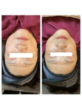 アイビー/エイジングケア！BBL体験