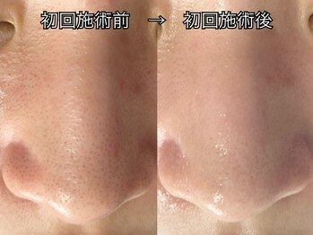 ムーンサン(Moon sun)/毛穴ケア×陶肌ピール　¥14300～