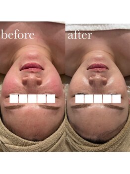 美〇工房 心斎橋店(B-Labo)の写真/【圧倒的小顔ツヤ肌】最新の韓国肌育美容が受けられる!お肌のお悩み、美白効果、毛穴/ニキビケアにも!