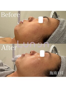 ルノン(Lunon)/毛穴洗浄ハイドロ×ララピール