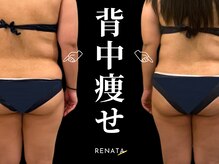 レナータ 銀座店(RENATA)の雰囲気（【脂肪冷却】Before・After/ダイエット銀座/池袋/渋谷/大宮）