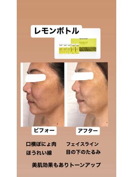 サロン ド ルルアス(Salon de LuLuas)/レモンボトル　ほうれい線ぼにょ