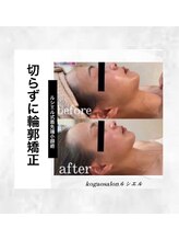 ルシエル/切らずに輪郭矯正