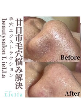 リエラ(Liella)/毛穴洗浄で小鼻もスッキリ