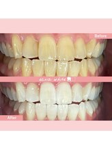 エクシアホワイトニング 札幌琴似店/ホワイトニングビフォーアフター