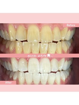 エクシアホワイトニング 札幌琴似店/ホワイトニングビフォーアフター