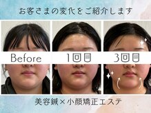 さくら鍼灸院 整骨院/美容鍼6