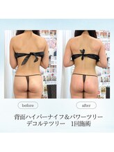 エスプレッソ(espresso,)/パワーツリーで筋膜リリース♪