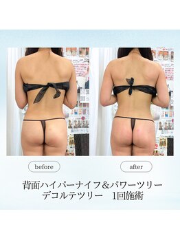 エスプレッソ(espresso,)/パワーツリーで筋膜リリース♪