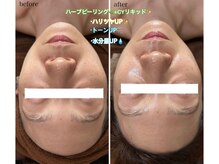 ウェレ(WELLE)/モニター様before after