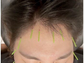 大河原はりきゅう整骨院/美容鍼