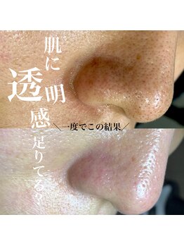 アーフ(ARF)/肌質改善