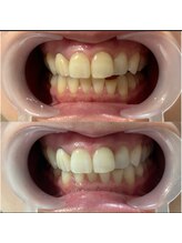 ワイズサロン(Y's salon)/ホワイトニング症例写真