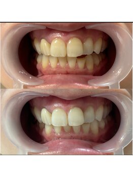 ワイズサロン(Y's salon)/ホワイトニング症例写真