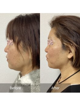 小顔整体 優/二重アゴ解消☆