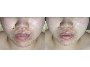 フィール(feel)/ビフォー アフター 1回施術