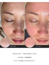 アパラギ(Aparagi)/【韓国肌管理】雪花ピール