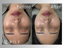 リリー(RILY)/【プラズマビフォーアフター】