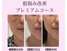 【肌悩み改善プレミアムコース】大きなシミや他店で断られた方も諦めないで!